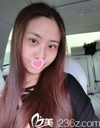 双眼皮手术7天后拆线的样子