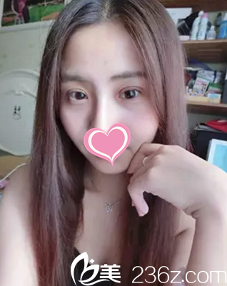 做完双眼皮15天双眼皮消肿不少