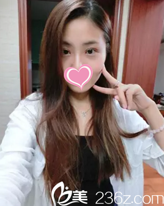 术后20天双眼皮慢慢恢复中