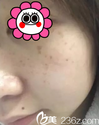 我去贵阳美莱医疗美容医院做激光祛斑 我去贵阳美莱医疗美容医院做激光祛斑