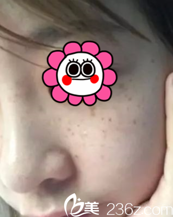 术前我脸上的斑 术前我脸上的斑