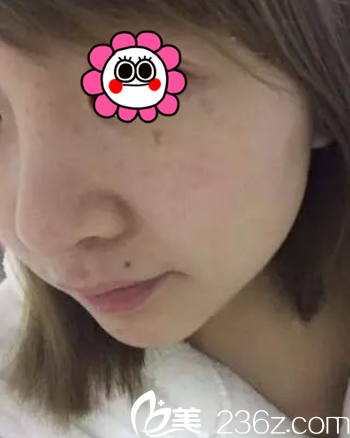 次做完感觉很多大斑点已经不见了 次做完感觉很多大斑点已经不见了