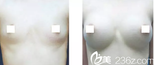 重庆东方整形邓光伟自体脂肪隆胸案例