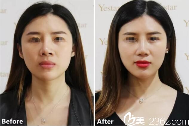 在南京艺星做隆鼻失败修复案例