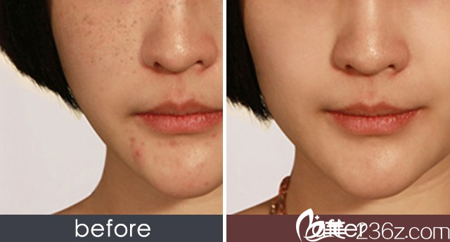 朴成哲院长激光祛斑效果