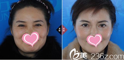 朴成哲院长除皱案例