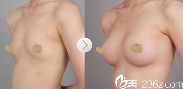 福州台江钟波假体隆胸案例图