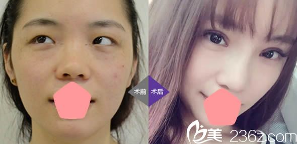 福州台江马美洲假体隆鼻和双眼皮案例