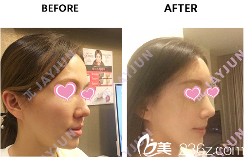 韩国JAYJUN整形外科鼻整形案例