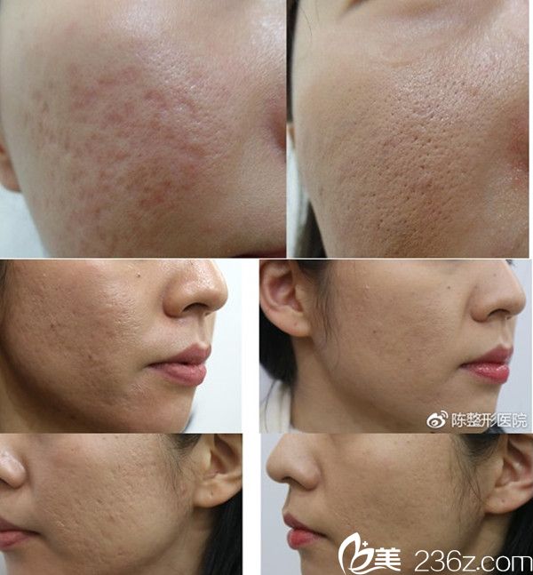韩国陈整形外科医院案例