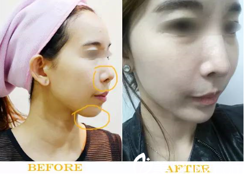 朴炯埈隆鼻加下颌角整形案例