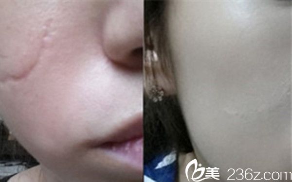 韩国陈整形外科医院院长陈世勋祛疤痕案例