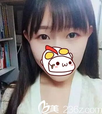 在长春圣颜做双眼皮手术前 在长春圣颜做双眼皮手术前