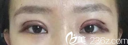 在长春圣颜做双眼皮手术当天 在长春圣颜做双眼皮手术当天