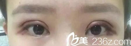 在长春圣颜做双眼皮手术第二天 在长春圣颜做双眼皮手术第二天