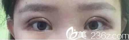 在长春圣颜做双眼皮手术第三天 在长春圣颜做双眼皮手术第三天