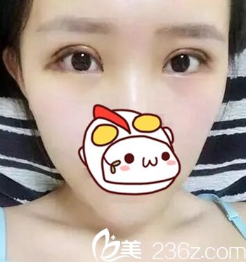 在长春圣颜做双眼皮手术后4天 在长春圣颜做双眼皮手术后4天