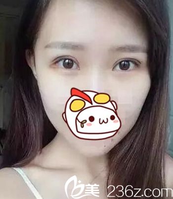 在长春圣颜做双眼皮手术后5天 在长春圣颜做双眼皮手术后5天