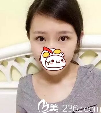 在长春圣颜做双眼皮手术后11天 在长春圣颜做双眼皮手术后11天