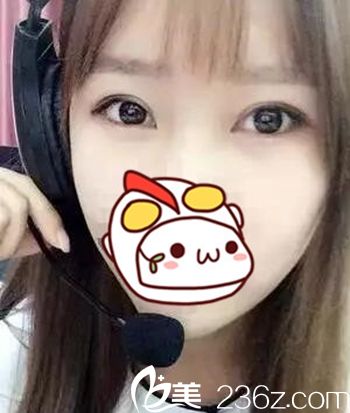 在长春圣颜做双眼皮手术后40天 在长春圣颜做双眼皮手术后40天