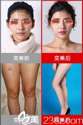 郑州悦美鼻综合和腿吸脂案例