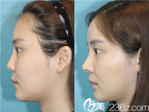 韩国碧夏整形医院案例