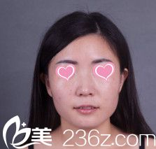 做鼻综合整形前鼻子塌平 做鼻综合整形前鼻子塌平