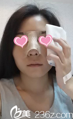 术后第2天鼻子慢慢恢复中 术后第2天鼻子慢慢恢复中