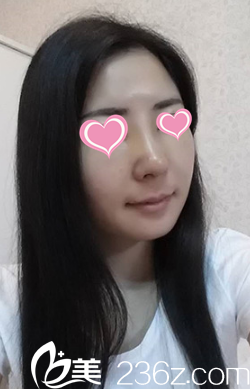 做鼻综合整形7天拆线后的样子 做鼻综合整形7天拆线后的样子