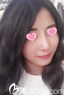 20天自然美鼻效果秀出来 只因在邢台博爱采用射极峰膨体做鼻综合整形太靠谱