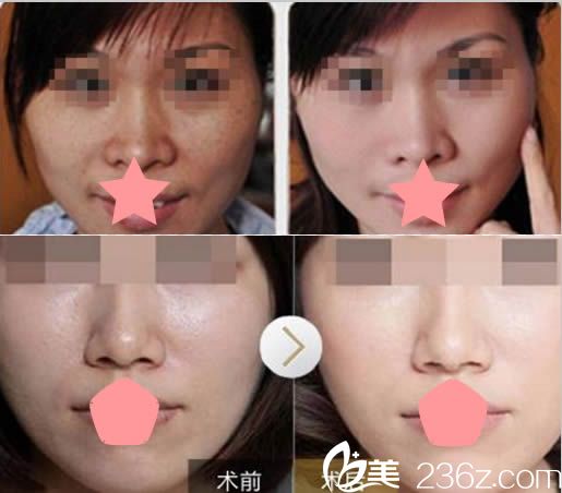 黄富梅激光祛斑和嫩肤美白案例