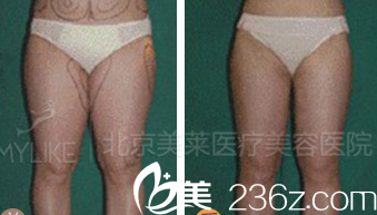 北京美莱医疗美容医院案例