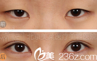 北京美莱医疗美容医院案例 北京美莱医疗美容医院案例