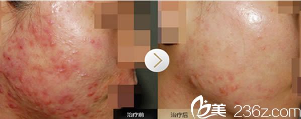 福州台江祛痘前对比效果 福州台江祛痘前对比效果