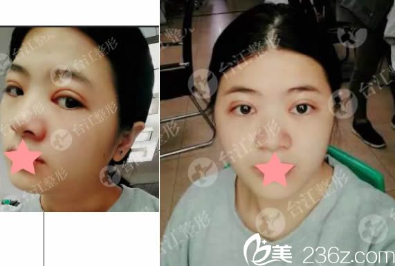 在福州台江做双眼皮术后15天恢复效果 在福州台江做双眼皮术后15天恢复效果