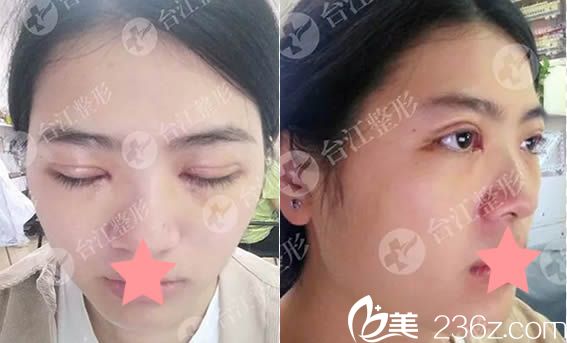 做完双眼皮一周后拆线的美照 做完双眼皮一周后拆线的美照