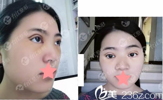 蝴蝶媚眼双眼皮术后天的样子 蝴蝶媚眼双眼皮术后天的样子