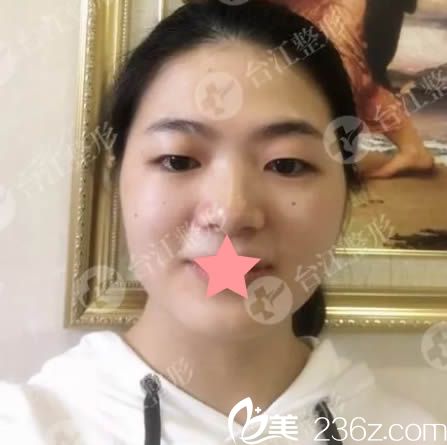 在福州台江整形医院做双眼皮术前照 在福州台江整形医院做双眼皮术前照