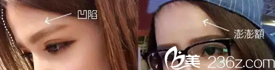 陈宏荣整形怎么样?看微整形效果图 陈宏荣整形怎么样?看微整形效果图