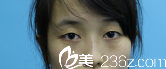 未做注射隆鼻之前的照片 未做注射隆鼻之前的照片