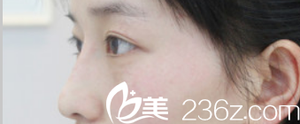 合肥台美丽格整形好不好?看玻尿酸隆鼻即刻效果展示 合肥台美丽格整形好不好?看玻尿酸隆鼻即刻效果展示