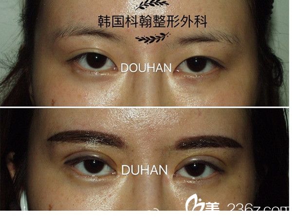 申枓翰院长双眼皮修复案例