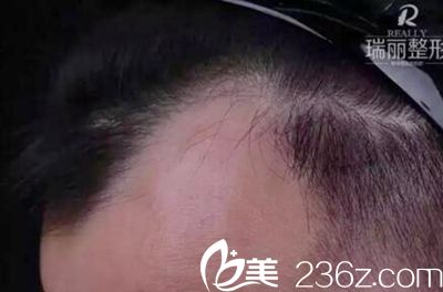 黑龙江瑞丽植发案例