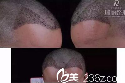 瑞丽植发术后第10天