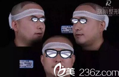 瑞丽植发术后即刻效果