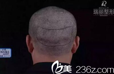 瑞丽植发取发区划线