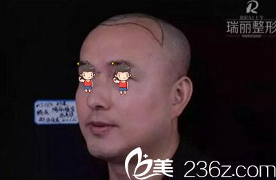 瑞丽植发术前左侧头部划线