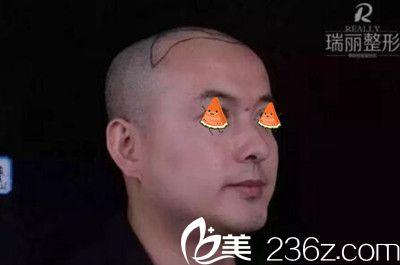 瑞丽植发术前右侧头部划线