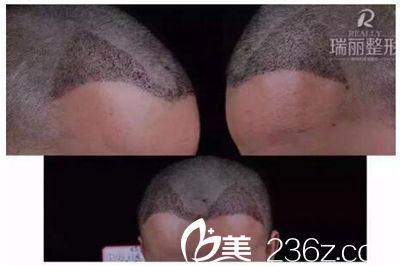 瑞丽植发术后第5天