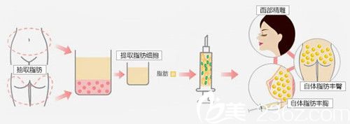 韩国必当归整形医院自体脂肪填充 韩国必当归整形医院自体脂肪填充